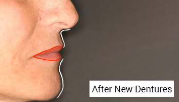 After-Implant-Supported Dentures