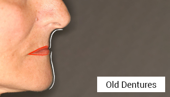 Before-Implant-Supported Dentures