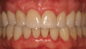 After-Full Mouth Rehabilitation
