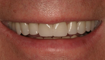 After-Full Mouth Rehabilitation