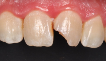 Before-test
