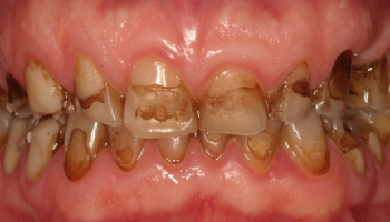 Before-Full Mouth Rehabilitation