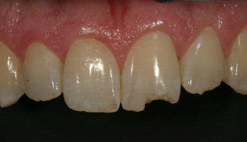 Before-test