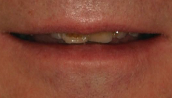 Before-Full Mouth Rehabilitation