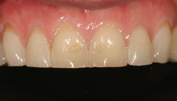 Before-test