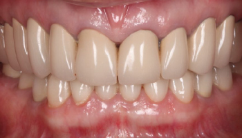 Before-Full Mouth Rehabilitation