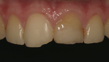 Before-test