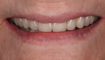 Before-Full Mouth Rehabilitation