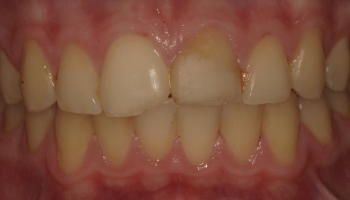 Before-test