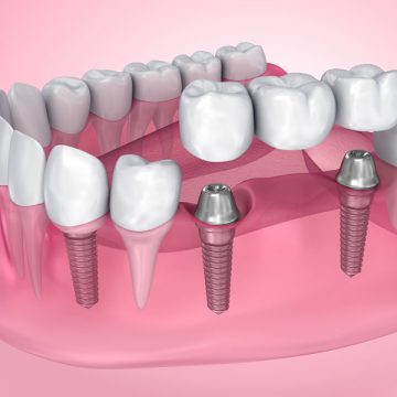 An Overview of Dental Bridges