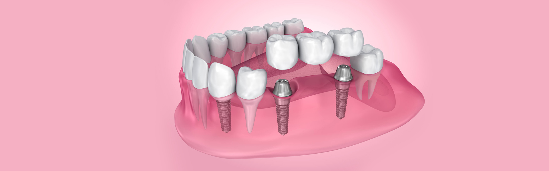 An Overview of Dental Bridges   