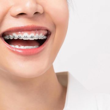 A Basic Guide to Orthodontics