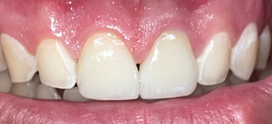 After image