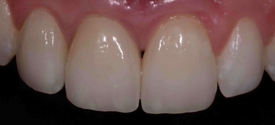 After image