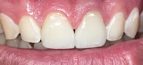 After image