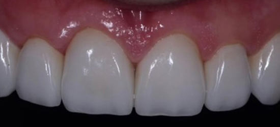 After image