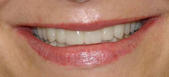 After image