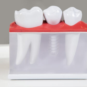 Can You Get a Single Tooth Implant?