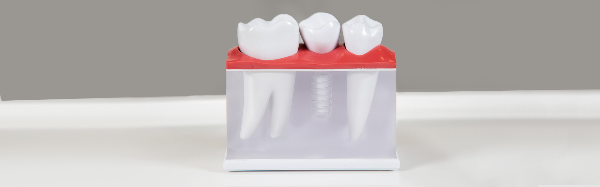 Can You Get a Single Tooth Implant?