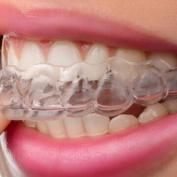 What Happens if You Don’t Use Invisalign?