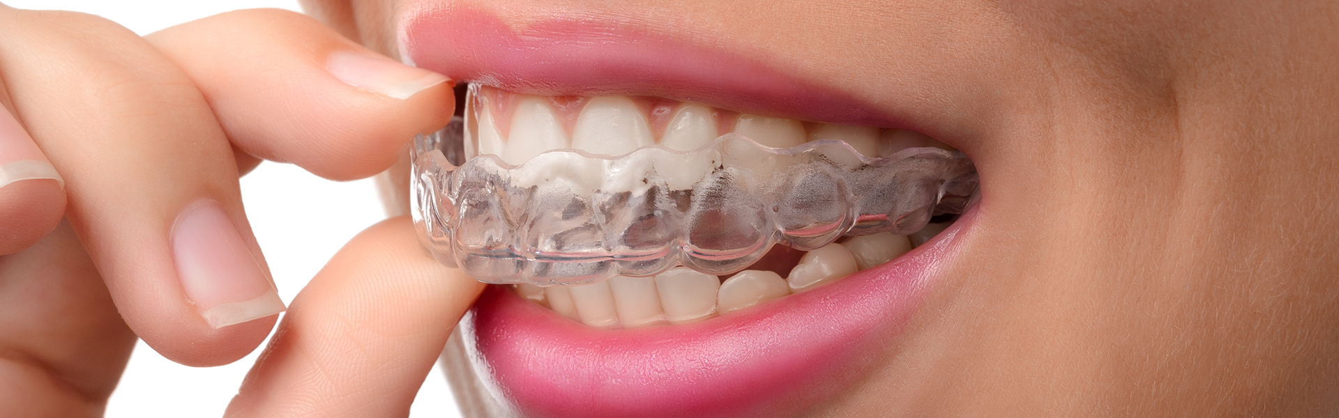 What Happens if You Don't Use Invisalign?