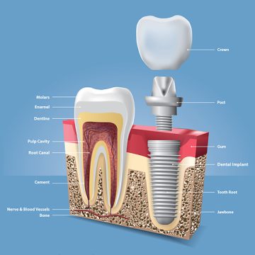 Understanding the Immediate Implant Placement Procedure: A Step-by-Step Guide
