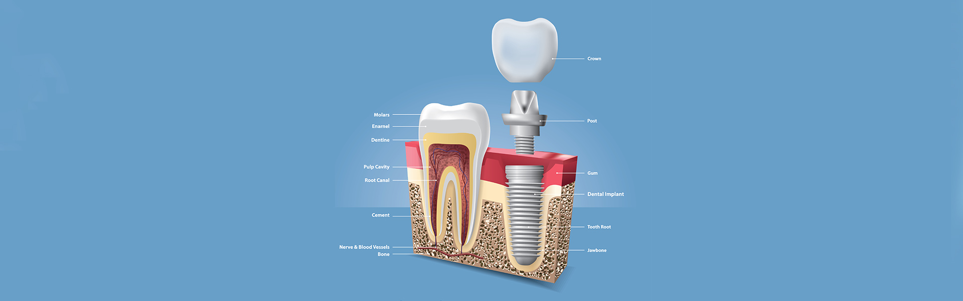Understanding the Immediate Implant Placement Procedure: A Step-by-Step Guide